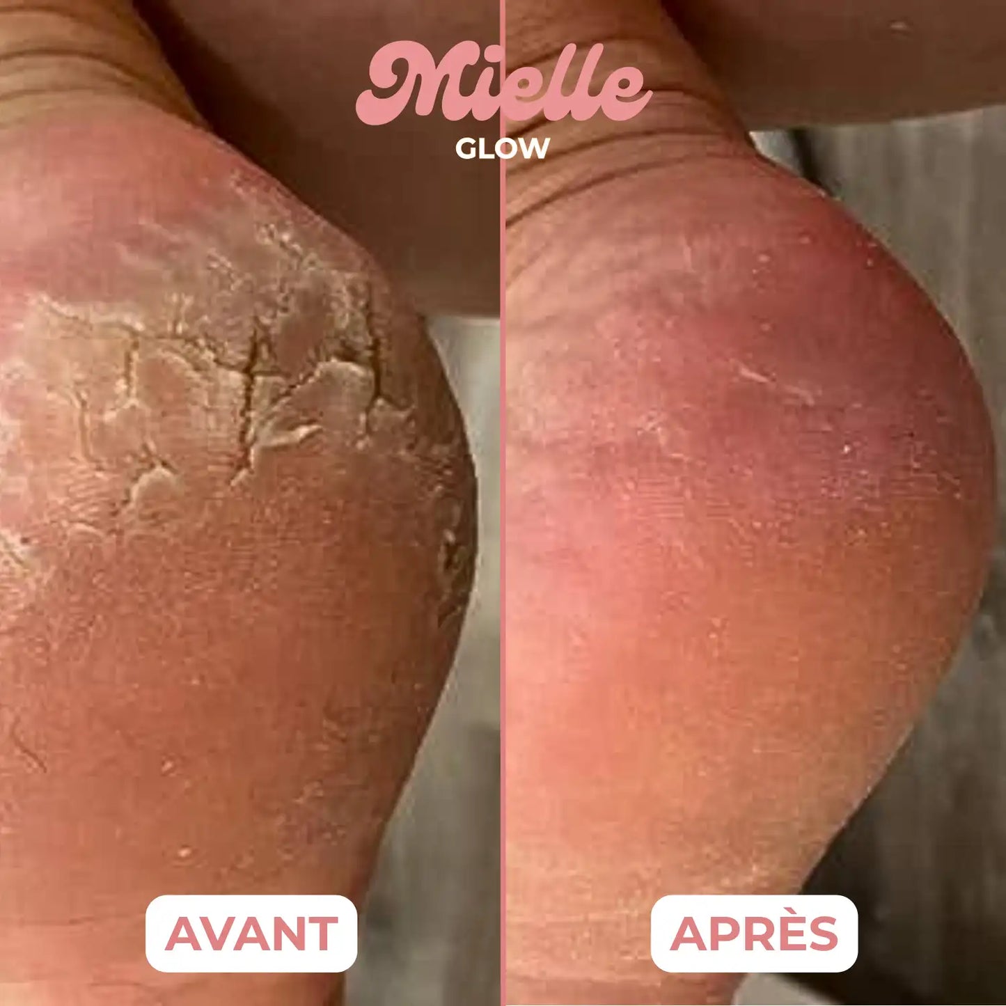 🍯 HoneyBalm™ – Baume Hydratant au Miel pour les pieds